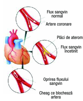 Infarctul miocardic recent - stimularea in tulburarile de conducere legate de infarctului miocardic acut
